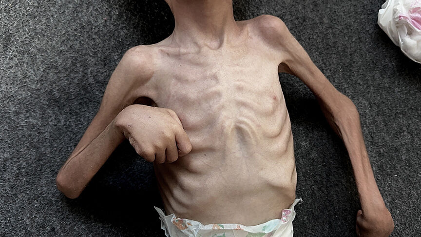 Gazze'de açlıktan ölen çocukların sayısı 289'a yükseldi - 2. Resim