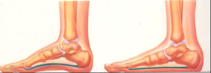 Sadece omurga değil, ayaklar da tehlikede! Uzmanlardan uyardı: Her yıl söyleniyor ama veliler dikkat etmiyor Sadece omurga değil, ayaklar da tehlikede! Uzmanlardan uyardı: Her yıl söyleniyor ama veliler dikkat etmiyor - 2. Resim