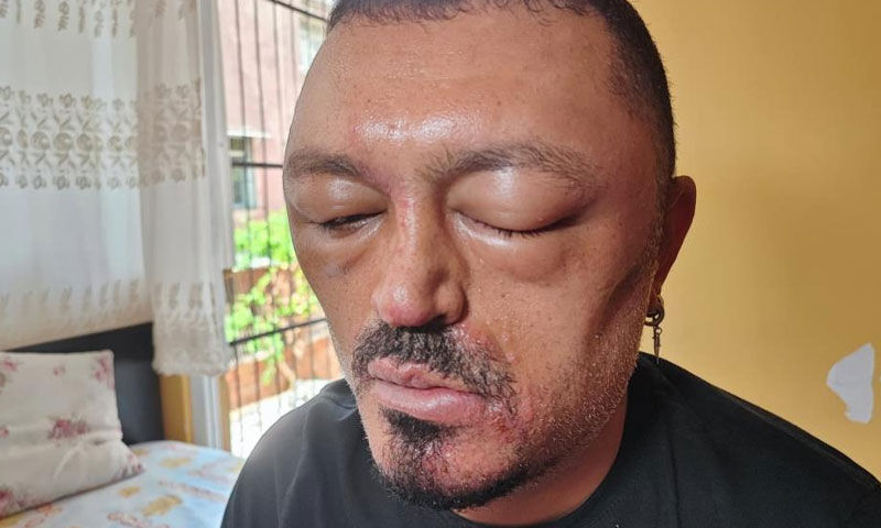 İnternetten aldığı şampuan hayatını kararttı! “Gözlerimi kaybedeceğim diye korktum” - 1. Resim