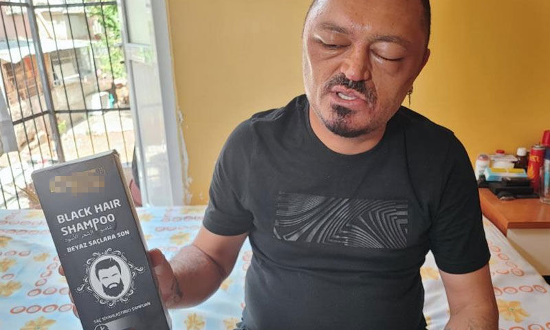 İnternetten aldığı şampuan hayatını kararttı! “Gözlerimi kaybedeceğim diye korktum” - 2. Resim