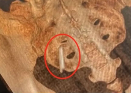 Duyanlar kulaklarına inanamıyor! 22 yıl boyunca kalçasında termometreyle yaşadı Hayatının şokunu yaşadı! 22 yıl boyunca kalçasında termometreyle yaşadı - 1. Resim
