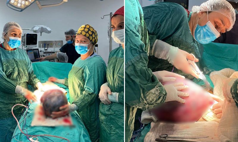 Hastaneye gidince ortaya çıktı! Karnını kaplayan dev kitle ameliyatla alındı Hastaneye gidince ortaya çıktı! Karnını kaplayan dev kitle ameliyatla alındı - 1. Resim