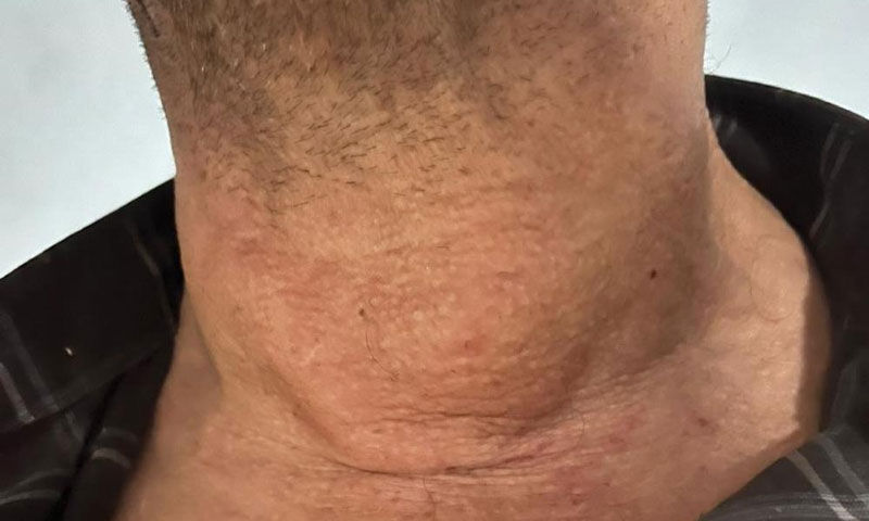 Nefes darlığı yaşıyordu… Boynu bir anda şişti, gerçek hastanede ortaya çıktı Nefes darlığı yaşıyordu… Boynu bir anda şişti, gerçek hastanede ortaya çıktı - 2. Resim