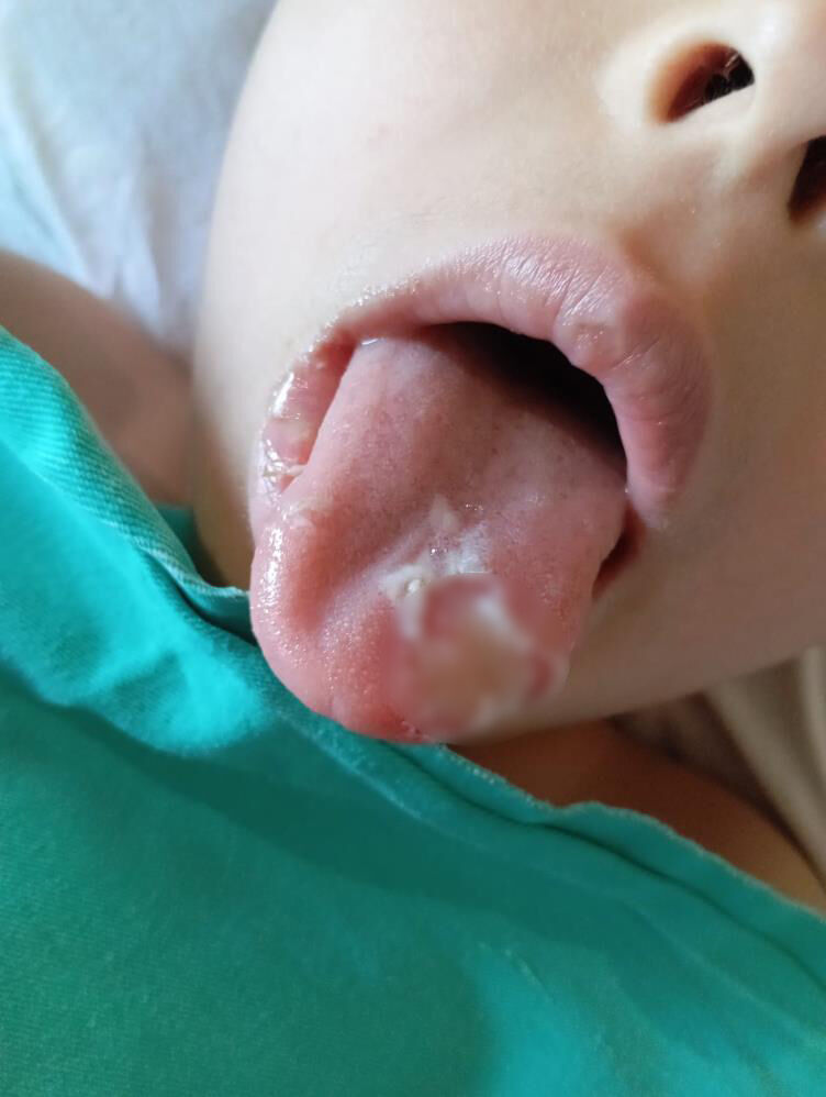 Nevşehir'de akılalmaz olay! 5 yaşındaki çocuğun ameliyatta dili ve dudağı yandı Nevşehir'de akılalmaz olay! 5 yaşındaki çocuğun ameliyatta dili ve dudağı yandı - 1. Resim