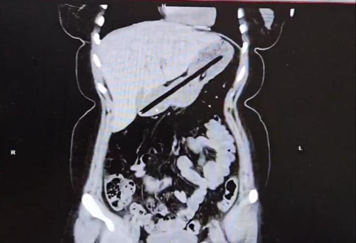 Mide ağrısıyla gitti! 2 kalem çıkardılar - 1. Resim