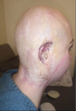 İngiltere'de iş yerinde saçı matkaba dolanmıştı! Genç anneye rekor tazminat İngiltere'de iş yerinde saçı matkaba dolanmıştı! Kazandığı tazminat dudak uçuklattı - 3. Resim