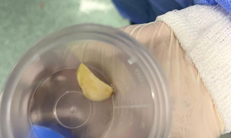 Nefes darlığı şikayetiyle gitti, akciğerinden ‘sarımsak’ çıktı - 2. Resim