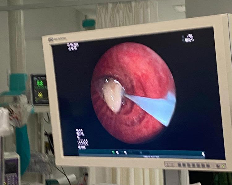 Nefes darlığı şikayetiyle gitti, akciğerinden ‘sarımsak’ çıktı - 1. Resim