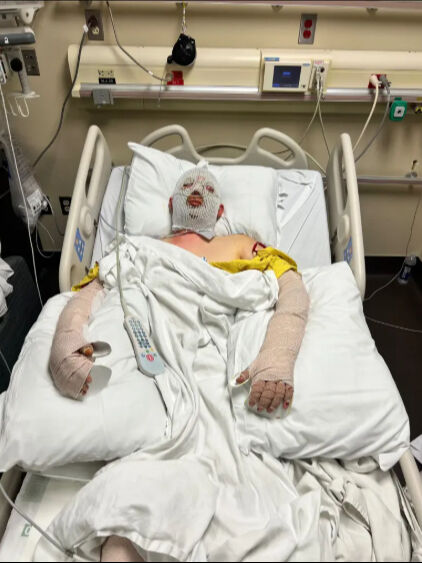 ABD'de alkollü sürücü dehşeti! Aracın benzin deposu patladı, 19 yaşındaki genç kabusu yaşadı - 2. Resim