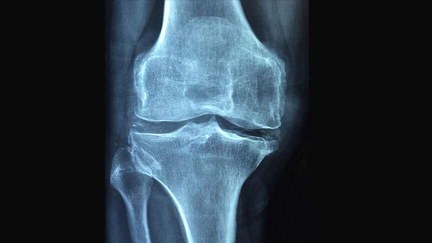 Diz Osteoartriti hastalarına yeni tedavi yöntemi! Düşük radyasyonla ağrılar azalacak - 1. Resim