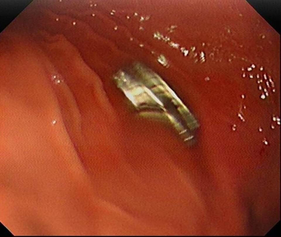 Kimse nasıl olduğunu anlamadı! Küçük çoğunu boğazından 19 mıknatıs çıktı - 1. Resim