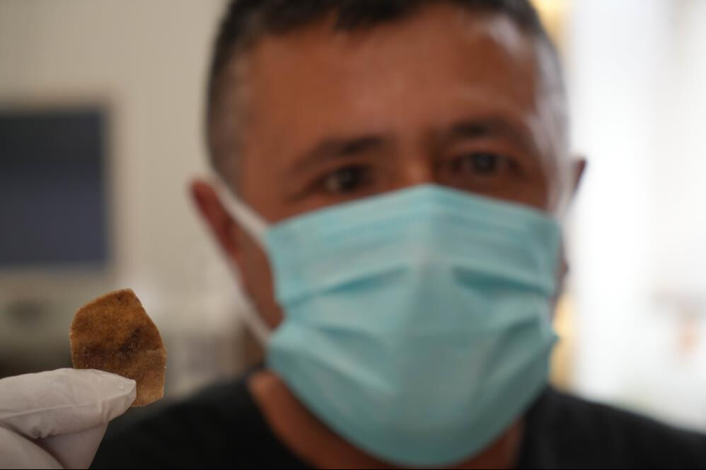 Protez gözündeki parça burnuna kaydı, çile dolu günleri başladı! - 1. Resim