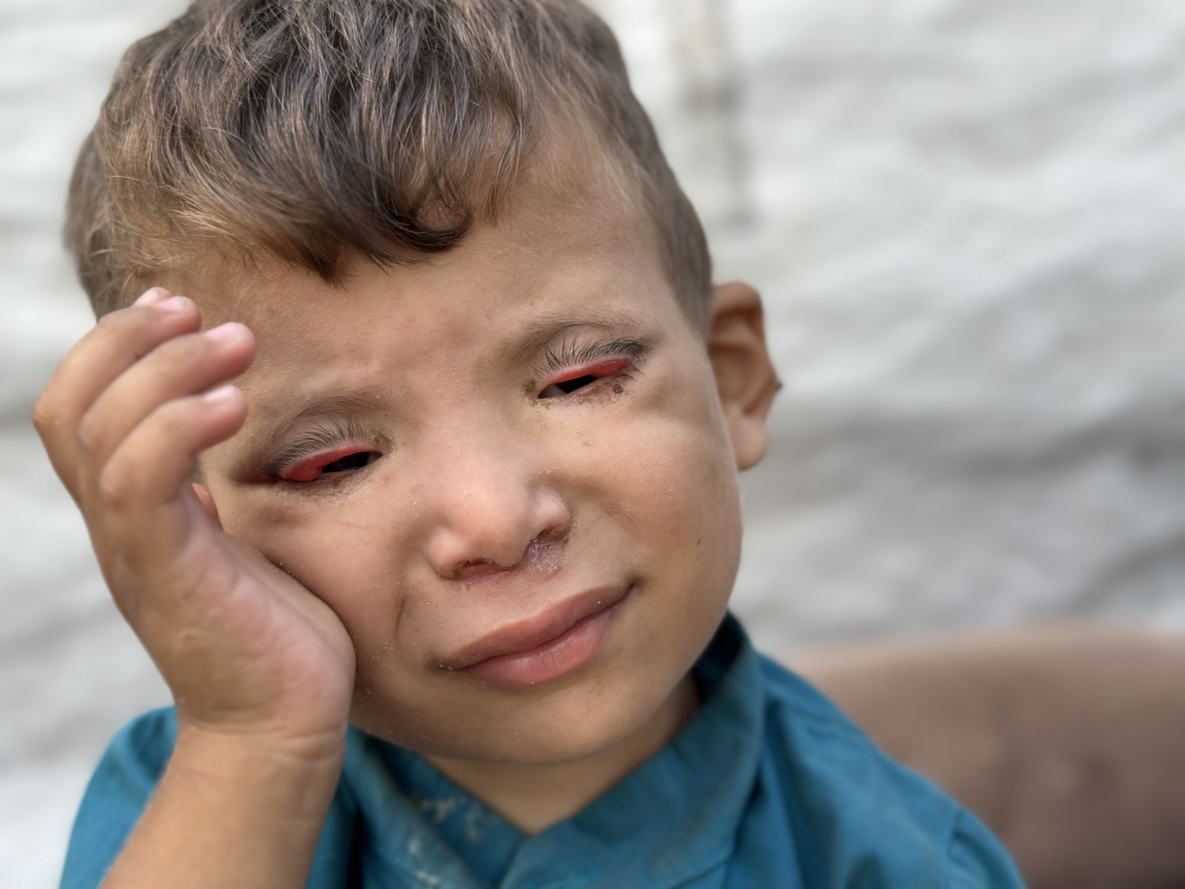 Kıtlıkla kuşatılan Gazze’de 'göz kapağı' hastası 3 yaşındaki Ramez yardım bekliyor - 2. Resim