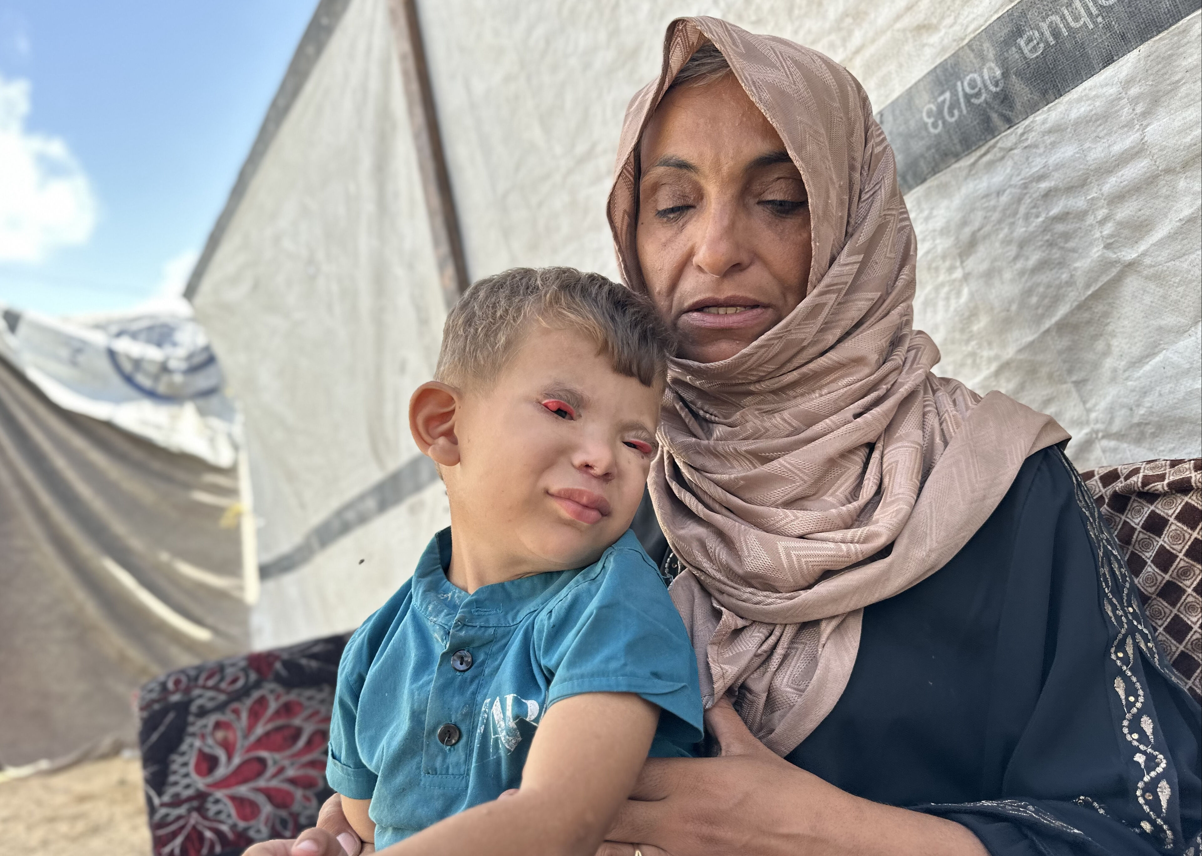 Kıtlıkla kuşatılan Gazze’de 'göz kapağı' hastası 3 yaşındaki Ramez yardım bekliyor - 1. Resim