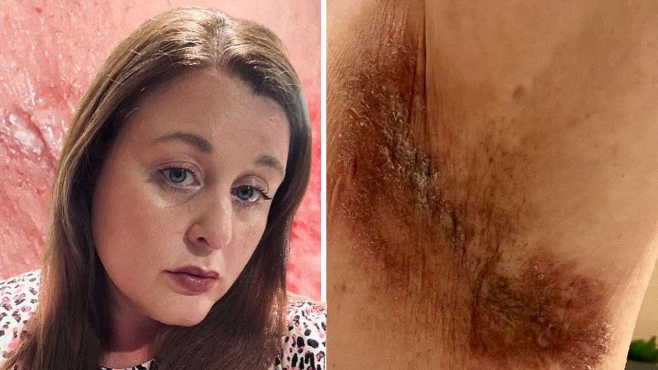 Ünlü markanın deodorantı ciltlerini yaktı! Yüzlerce kadın kabusu yaşadı Ünlü markanın deodorantı ciltlerini yaktı! Yüzlerce kadın kabusu yaşadı