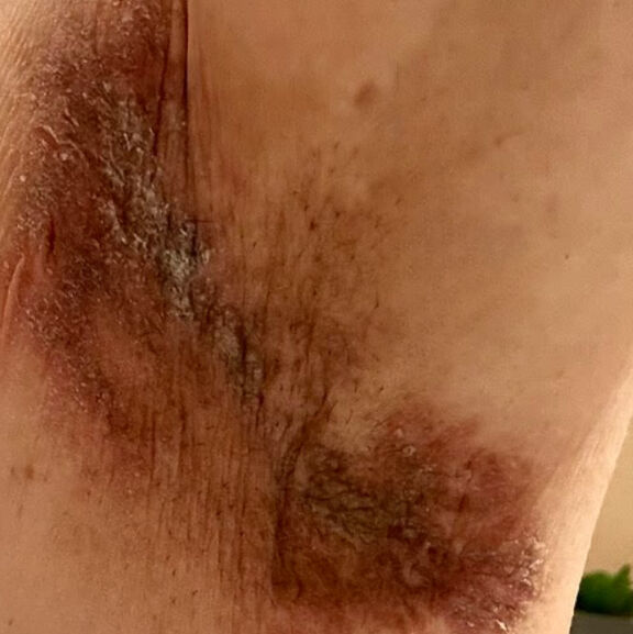 Ünlü markanın deodorantı ciltlerini yaktı! Yüzlerce kadın kabusu yaşadı - 2. Resim