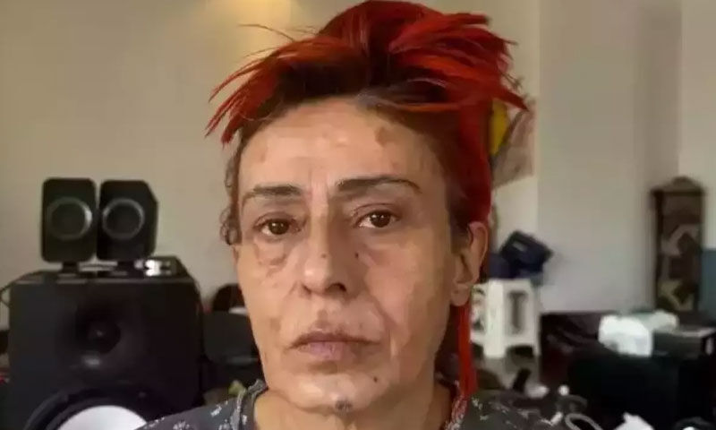 Yıldız Tilbe’nin yüzündeki yara izleri takipçilerini korkuttu - 2. Resim