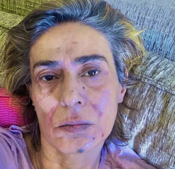 Yıldız Tilbe’nin yüzündeki yara izleri takipçilerini korkuttu - 1. Resim