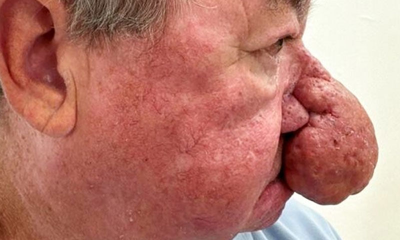 Burnu ağzını kapatacak kadar büyüdü, yemek yiyemedi… Verdiği karar hayatını değiştirdi - 1. Resim