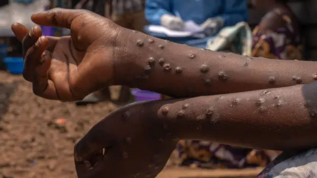 Ölümcül mpox virüsü hızla artıyor! Son bir haftada 26 vaka - 1. Resim