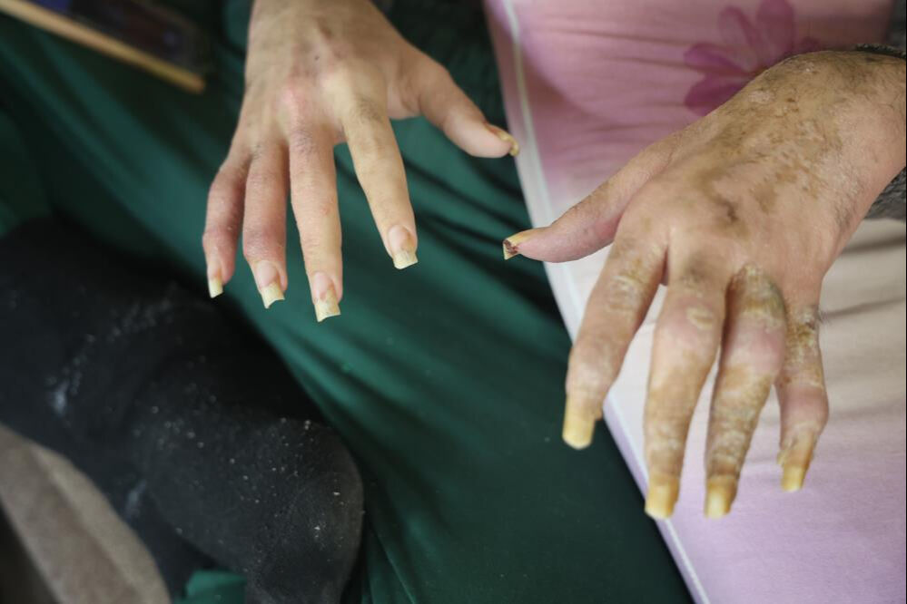 6 Şubat depremi hayatını kararttı! 3 yıldır evden çıkmıyor, banyo yapmıyor, tırnak kesmiyor... - 5. Resim