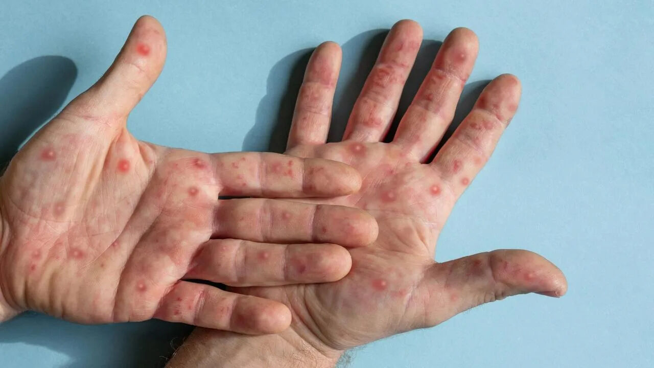 Büyük şehirde yeni bir virüs salgını ortaya çıktı! Avustralya 'kırmızı alarm' dedi - 1. Resim