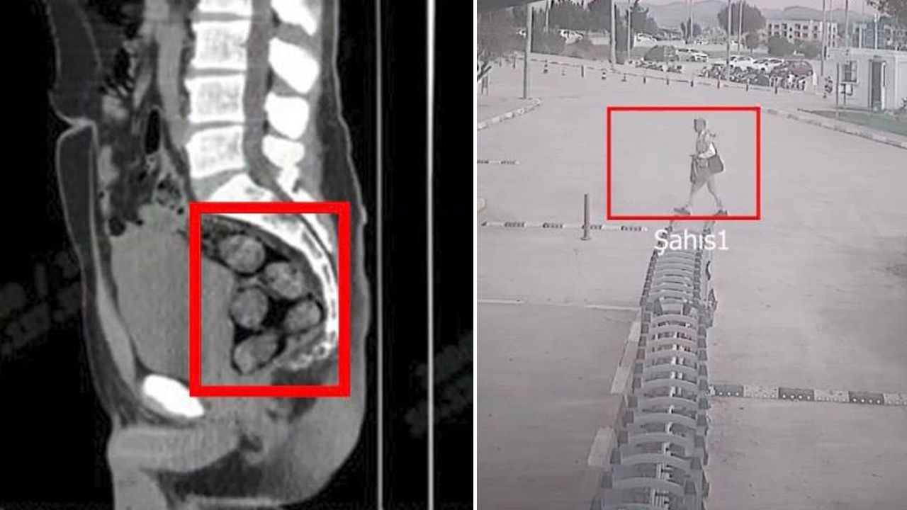  -Midesinden çıkanların ardından hapsi boyladı