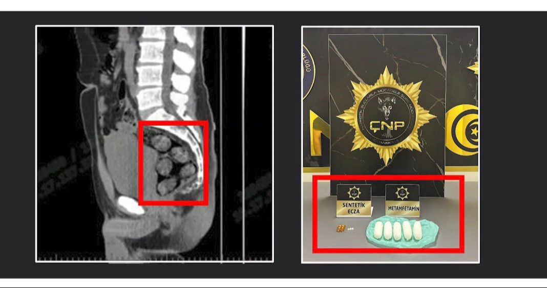 Tomografide şok eden görüntü! Midesinden çıkanların ardından hapsi boyladı - 2. Resim