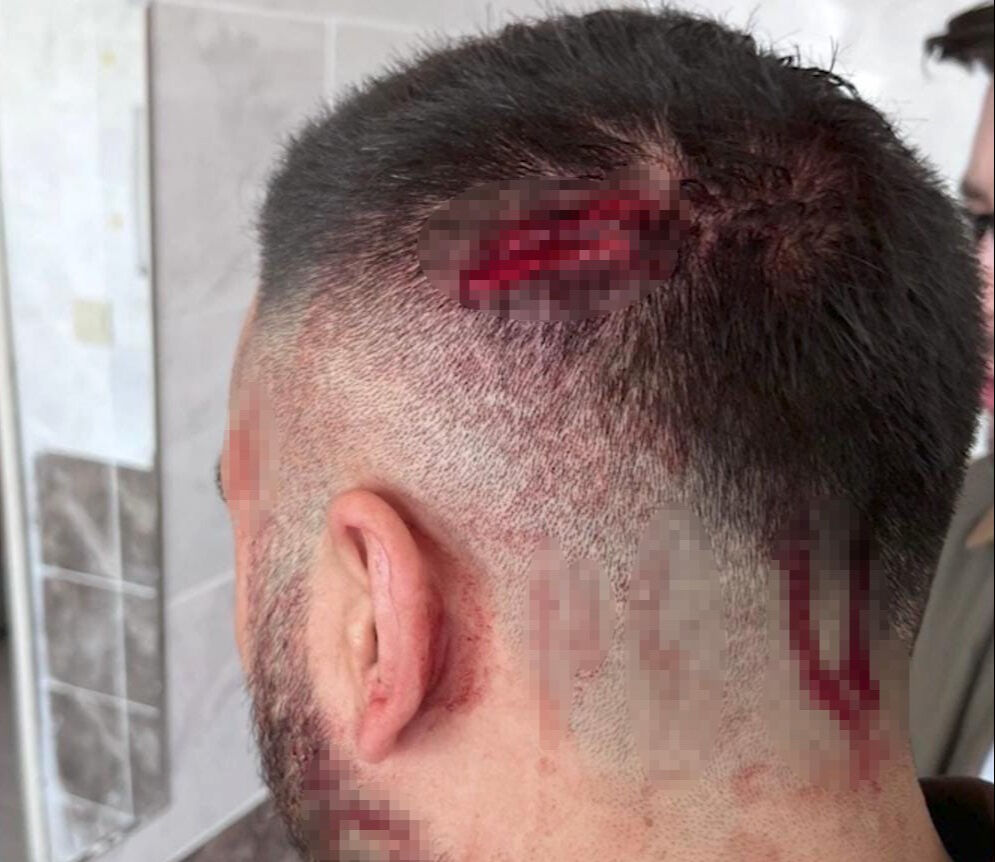 Şanlıurfa'da öğretmene sopalı saldırı! Kan revan içinde kaldı - 2. Resim