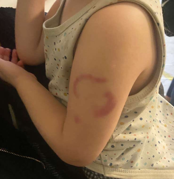 Edirne'de akılalmaz iddia! Kreşte öğretmen, 3 yaşındaki çocuğu ısırdı - 1. Resim