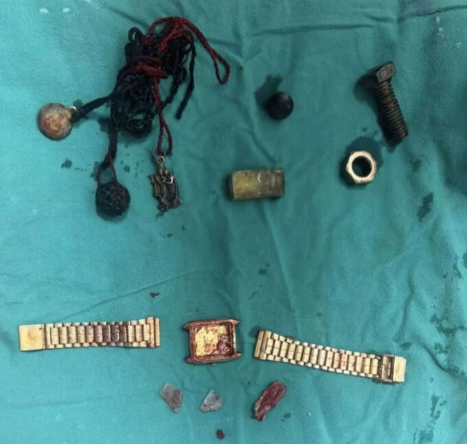 Karın ağrısı şikayetiyle gitmişti, midesinden öyle şeyler çıktı ki... Doktorlar bile şaşkına döndü - 1. Resim