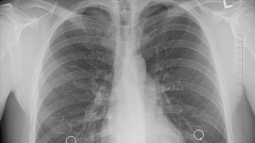 Sağlığınızı buna borçlu olabilirsiniz: İç çekmek akciğerlerinizi iyileştirebilir! - 2. Resim