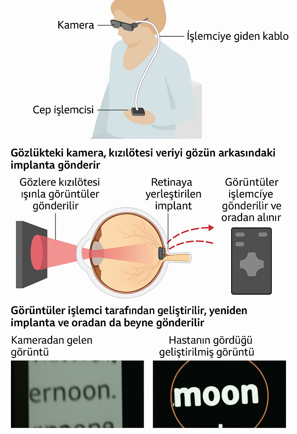 İngiltere'de biyonik göz çipi geliştirildi! Görme kaybı yaşayanlar, yeniden okumaya başladı - 5. Resim