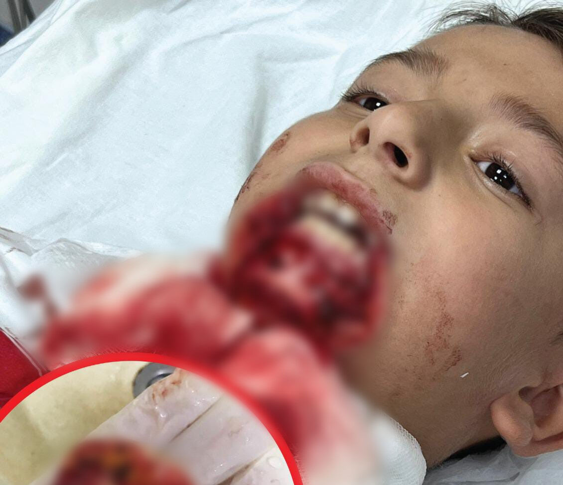 Çanakkale'de 7 yaşındaki çocuğun çenesi koptu! Ailesi hukuk mücadelesi başlattı - 2. Resim