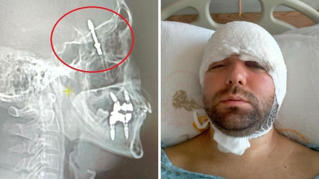 Beynine saplanan implant hayatını kabusa çevirdi! Diş hekimine verilen cezaya isyan etti Beynine saplanan implant hayatını kabusa çevirdi! Diş hekimine verilen cezaya isyan etti - 1. Resim