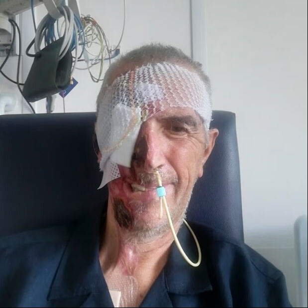 Kazada yüzünün yarısını kaybetmişti! 3D yazıcıyla yeniden yapıldı Kazada yüzünün yarısını kaybetmişti! 3D yazıcıyla yeniden yapıldı - 2. Resim