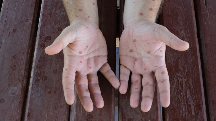 Avrupa’dan Afrika’ya sessizce yayılıyor! 'Her 100 kişiden birini öldürebilir' - 1. Resim