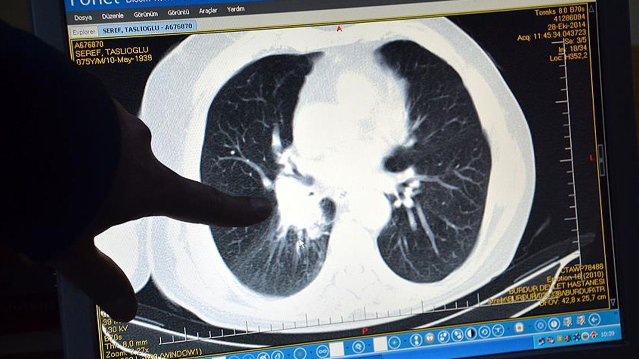  - Akciğer kanserinde radyoterapi sonucunu etkileyen 12 gen bulundu