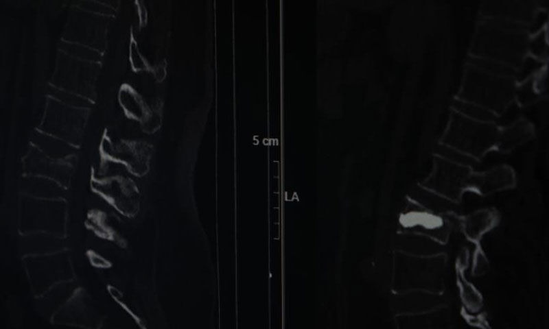 Aylarca fıtık zannetti… Gerçek çok başka çıktı: ‘Her gün doktoruma dua ediyorum’ Aylarca fıtık zannetti… Gerçek çok başka çıktı: ‘Her gün doktoruma dua ediyorum’ - 1. Resim