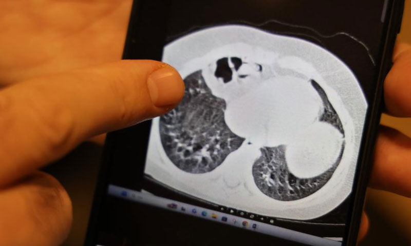 Küçük çocuğun bağırsakları göğüs boşluğuna çıkmış! Gizli hastalığı ortaya çıktı - 1. Resim