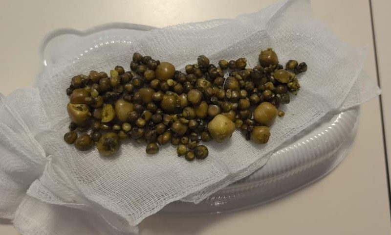 5 aydır ağrı çekiyordu… Bir saatlik operasyonda 213 taş çıktı - 1. Resim