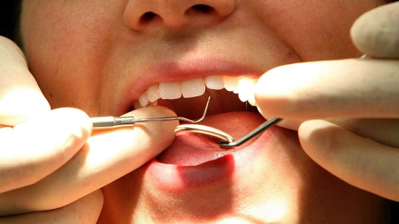  - Diş çürüğüne neştersiz çare bulundu! Dolgu tarih oluyor