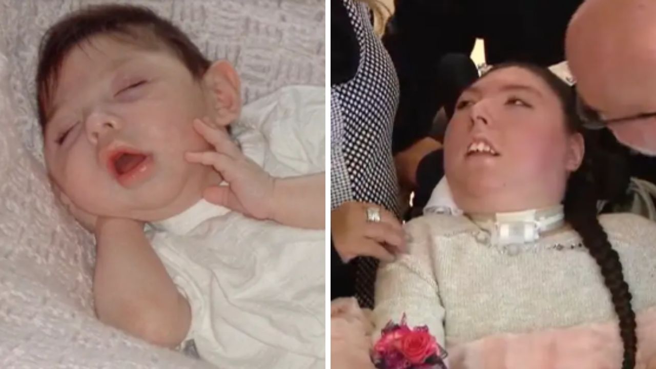 Beyni olmadan dünyaya gelmişti: Doktorlar &#039;5 yıl bile yaşamaz&#039; dedi, şimdi 20 yaşında