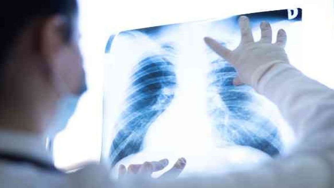 Belirti vermiyor ama ölümcül… Akciğer kanserinde erken tanı önemli Belirti vermiyor ama ölümcül… Akciğer kanserinde erken tanı önemli