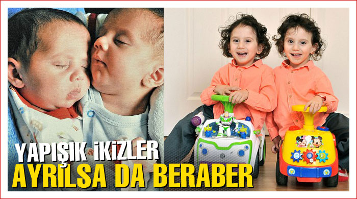 Yapışık ikizler ayrılsa da beraber