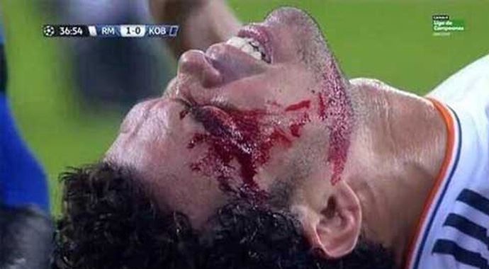 Real Madridli Pepe kanlar içinde kaldı Real Madridli Pepe kanlar içinde kaldı