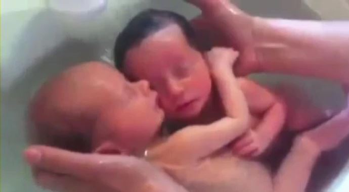 İkizler kendilerini hâlâ anne karnında sanıyorlar İkizler kendilerini hâlâ anne karnında sanıyorlar