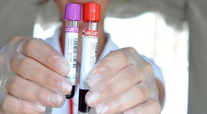 Down sedromu'nu erken teşhis için kan tahlili yapılacak Down sedromu'nu erken teşhis için kan tahlili yapılacak