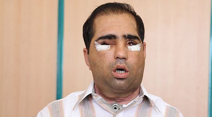 Yüz nakledilen hastaların tedavileri sürüyor