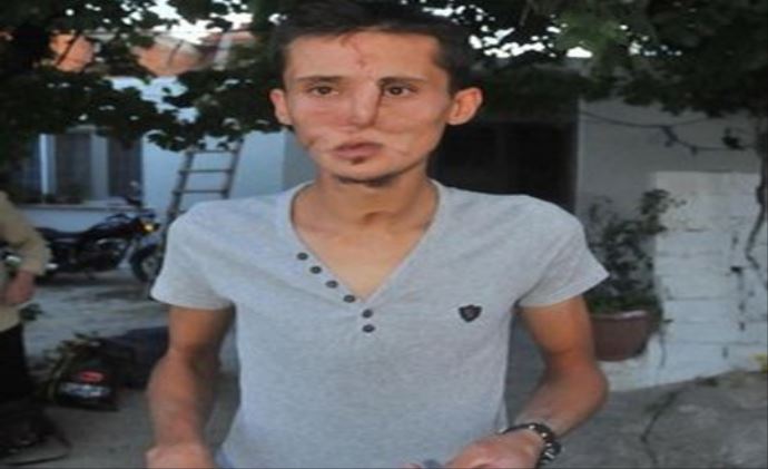 Yüz nakli hayali, ten farkı yüzünden olmadı Yüz nakli hayali, ten farkı yüzünden olmadı